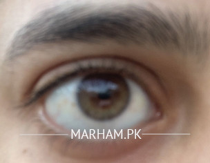 Eye Problems 