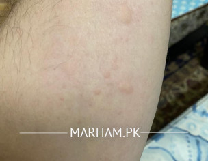 Skin Allergy 