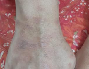 Irritating Skin Rash