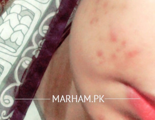 Pimple And Dryness