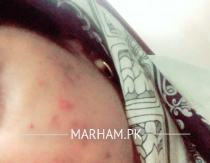 Pimple And Dryness