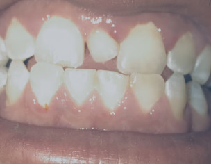Middle Upper Tooth Size And Dimensions Problem 