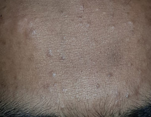 Skin. Acne