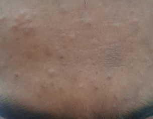 Skin. Acne