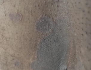Itching And Rashing