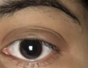 Eye Swollen 