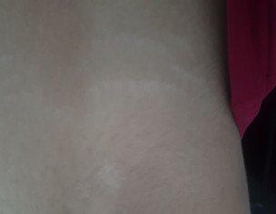 White Spots And Lines