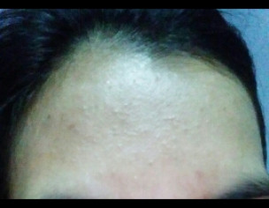 Tiny Pimples 