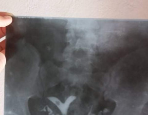 Bicarnuate Uterus