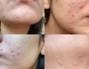 Acne/Hormones