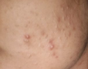 Face Skin Problem