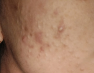 Face Skin Problem