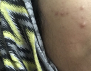 Acne And Spots 