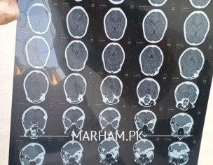Brain Problem