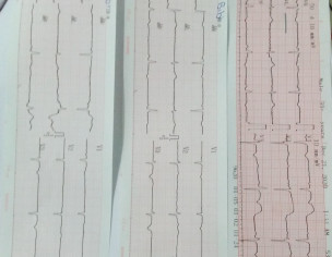 Coronary Artery 