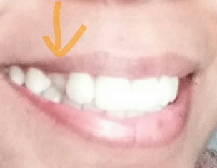 Teeth Issue.