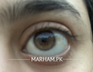 Eyes Problems