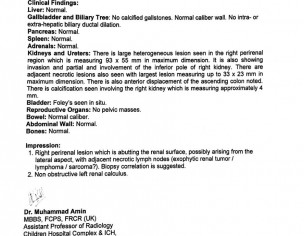 Sarcoma In Abdomen