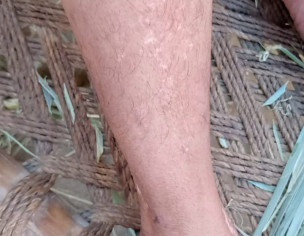 Skin Infection