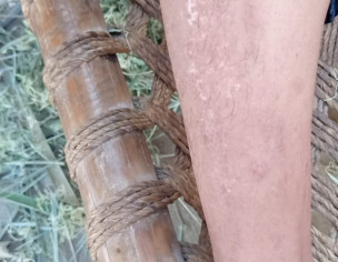 Skin Infection