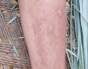 Skin Infection