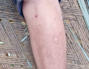 Skin Infection