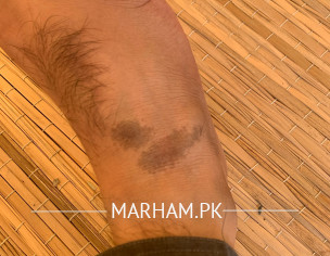 Feet Skin Problem