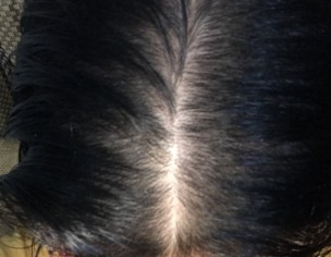 Hairfall
