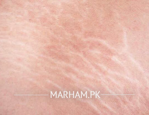 Marks On Lower Back