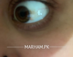 Eye Problems 