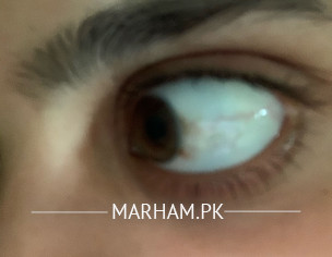Eye Problems 