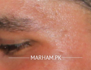 Face Problem