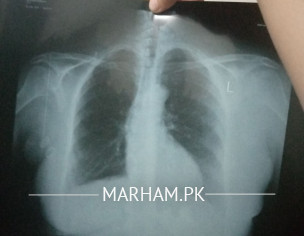 Heart Problem