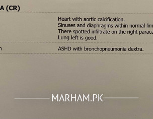 Cough Chest Xray