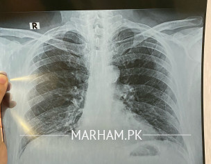 Cough Chest Xray