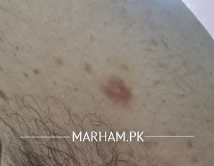 Skin Problem