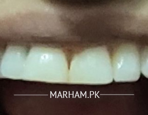Teeth Shape