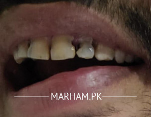 Teeth Problem