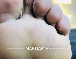 Skin Allergy 