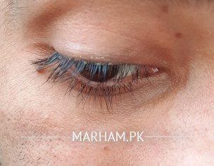 Eye Infection 