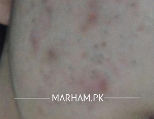 Acne On Face