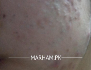 Acne On Face