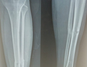 Bone Break After Removing Rod