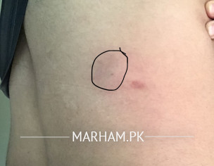 Lipoma/ Gilti
