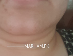 Brown Marks On Skin