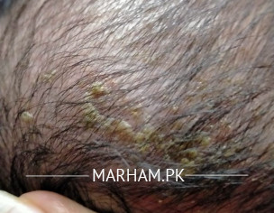 Dandruff