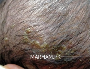 Dandruff