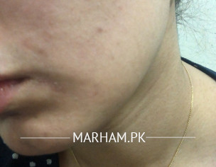 Skin Allergy 