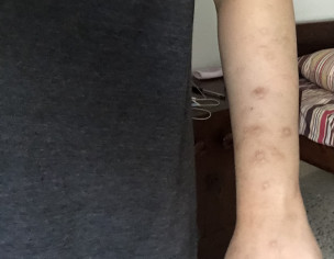 Skin Pigmentation