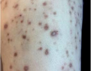 Skin Pigmentation